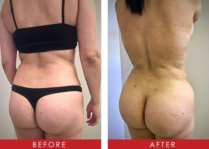 Before and After Photos of Naples Woman who had BBL in addition to Breast  Augmentation and Tummy Tuck