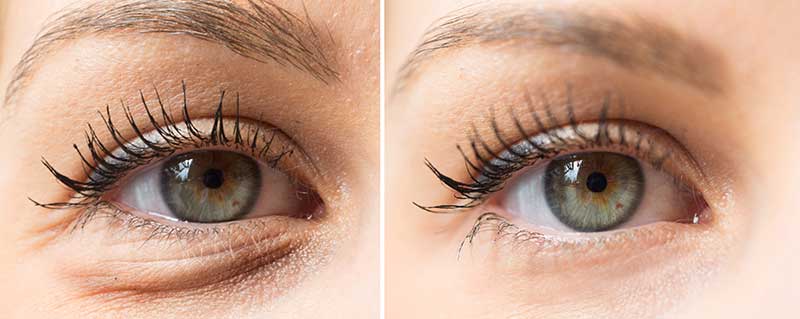 Blepharoplasty