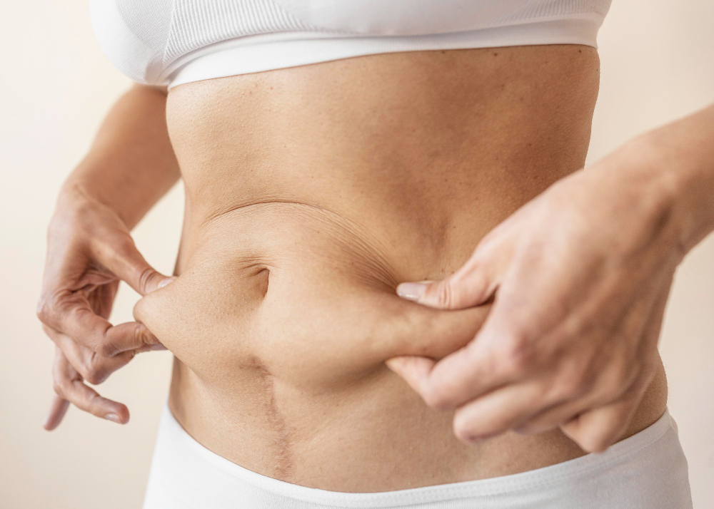 Tummy Tuck Surgery